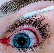 ناخنک چشم چیست؟ روش‌های درمان - دکترعینک