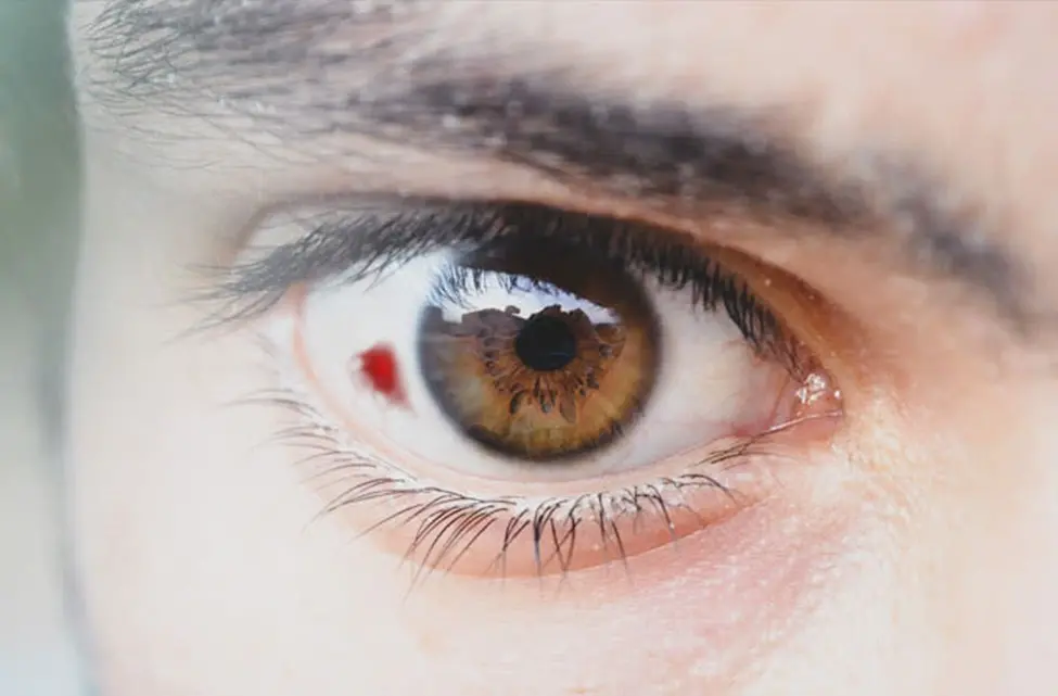چگونه باید لکه خون درون چشم را از بین برد؟