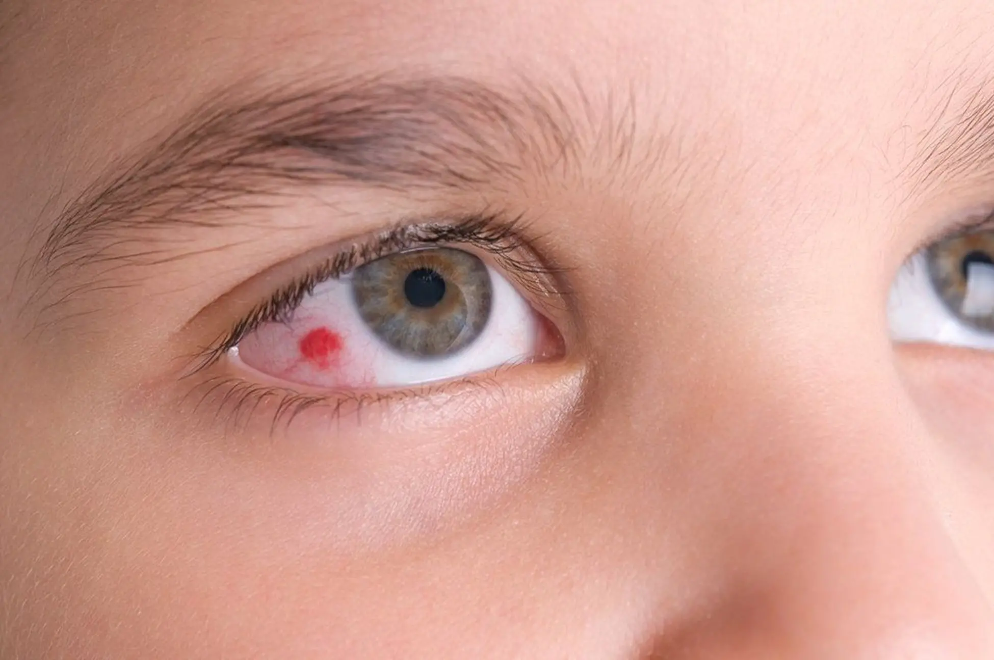 چه راهی برای از بین بردن لکه خون در چشم وجود دارد؟