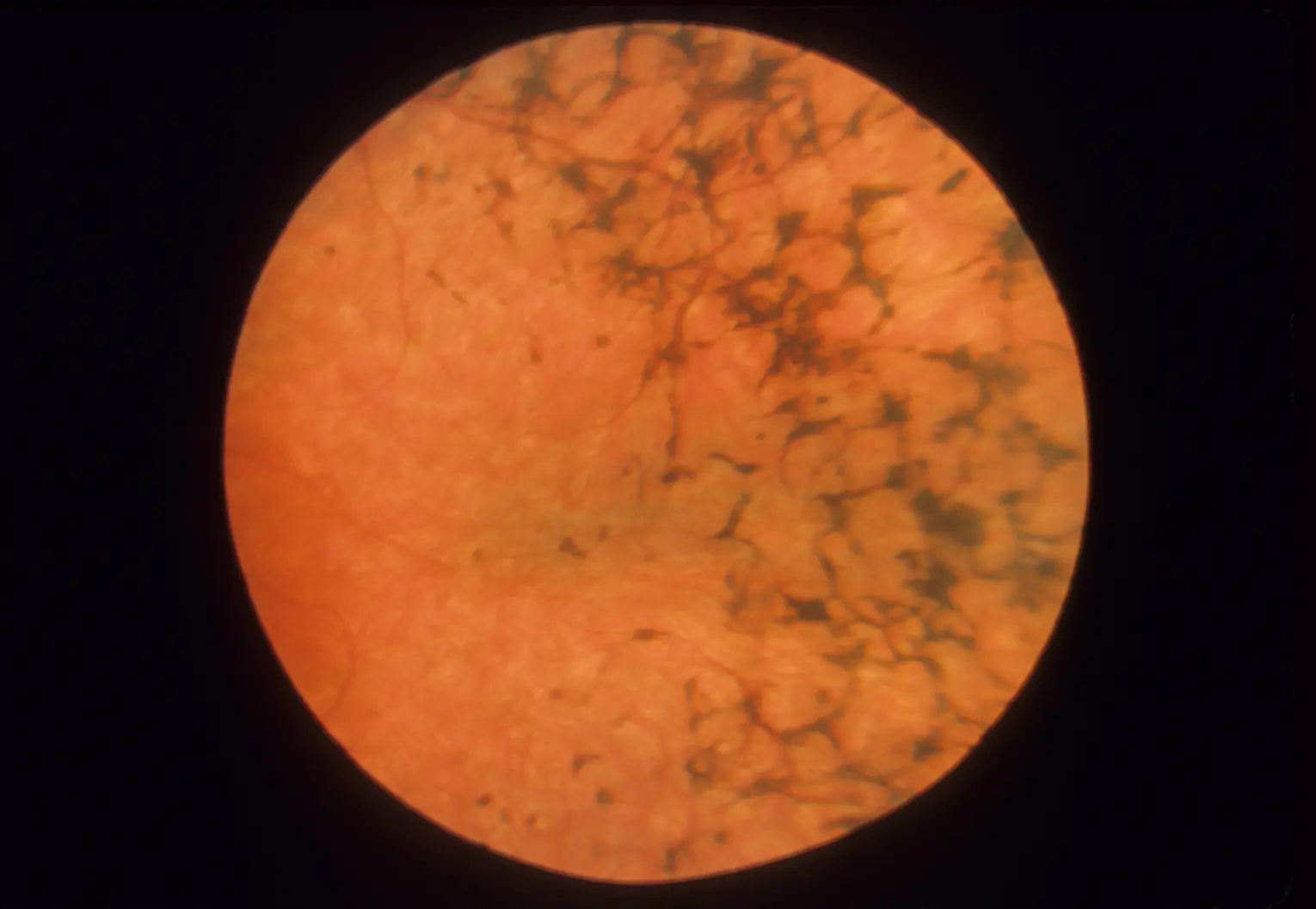 آیا درمان مشخصی برای رتینیت پیگمنتوزا چشم وجود دارد؟