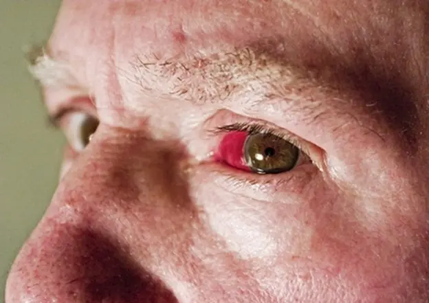 ایجاد شدن لکه خون در چشم نشانه چیست؟