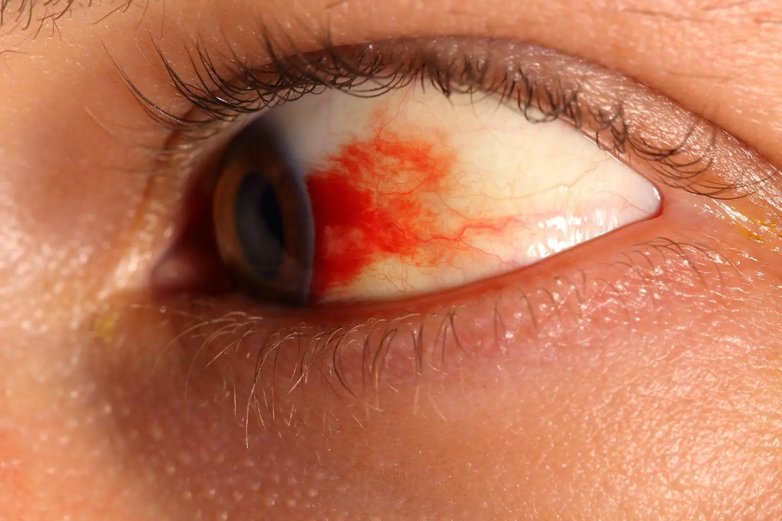 علائم رتینوپاتی چشم چیست؟