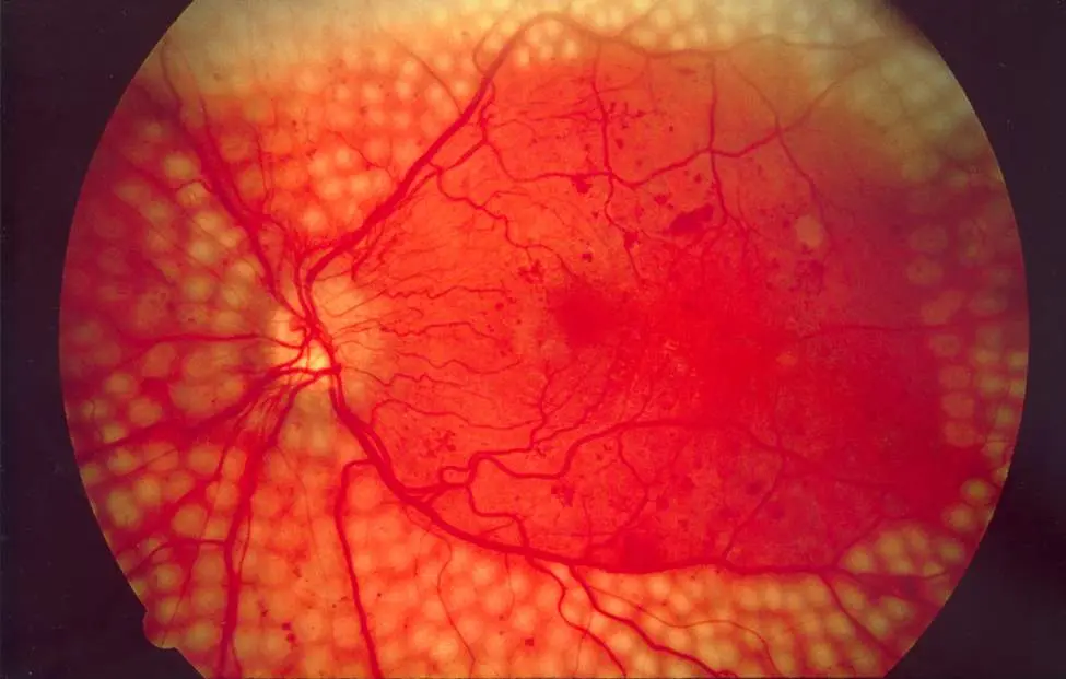 روند تشخیص رتینوپاتی چشم