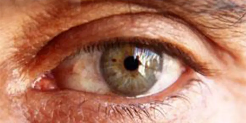 عوارض ویترکتومی چشم