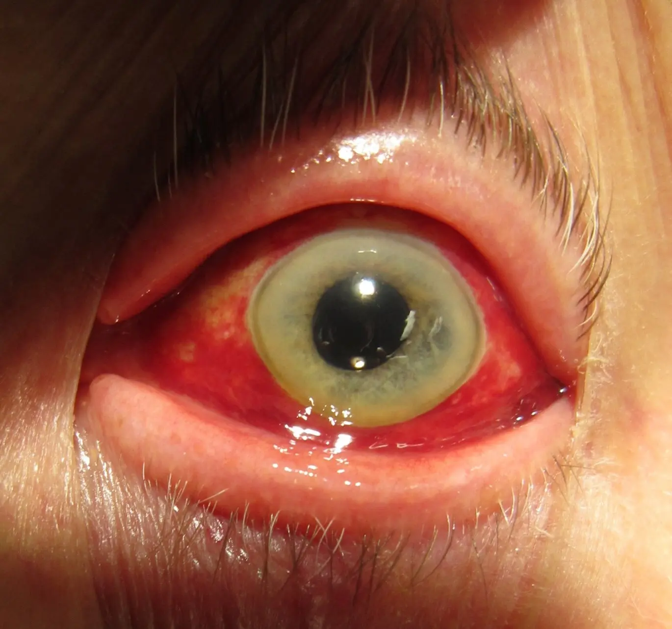درمان لکه خون در چشم با روش‌های خانگی