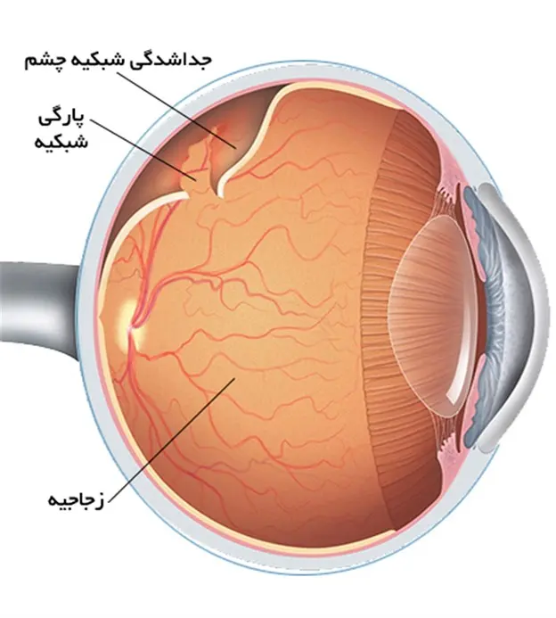 انجام عمل جداشدگی شکبیه چشم توسط دستگاه‌های مدرن