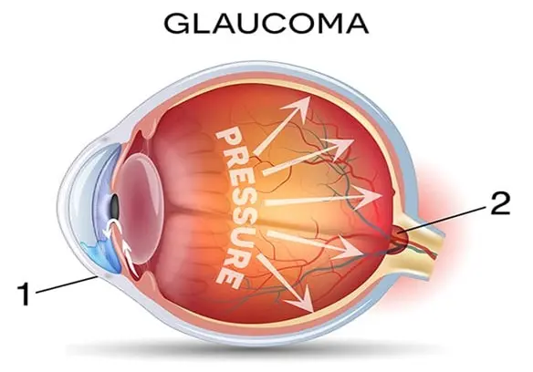 افزایش فشار چشم به دلیل تولید بیش از حد مایع چشم