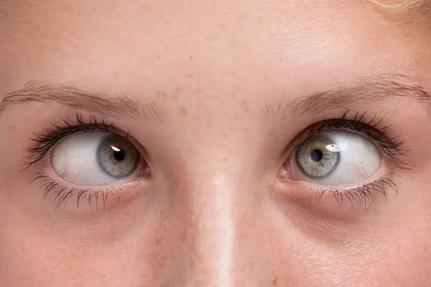 تشخیص بیماری انحراف چشم