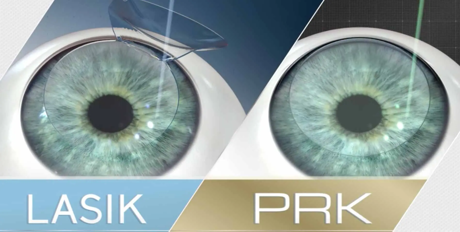 PRK یا لازک؟ کدام بهترند؟ - دکترعینک
