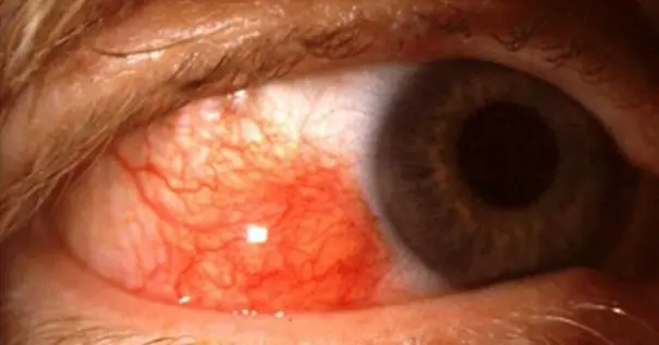 اسکلریت یکی از دلایل اصلی التهاب چشم