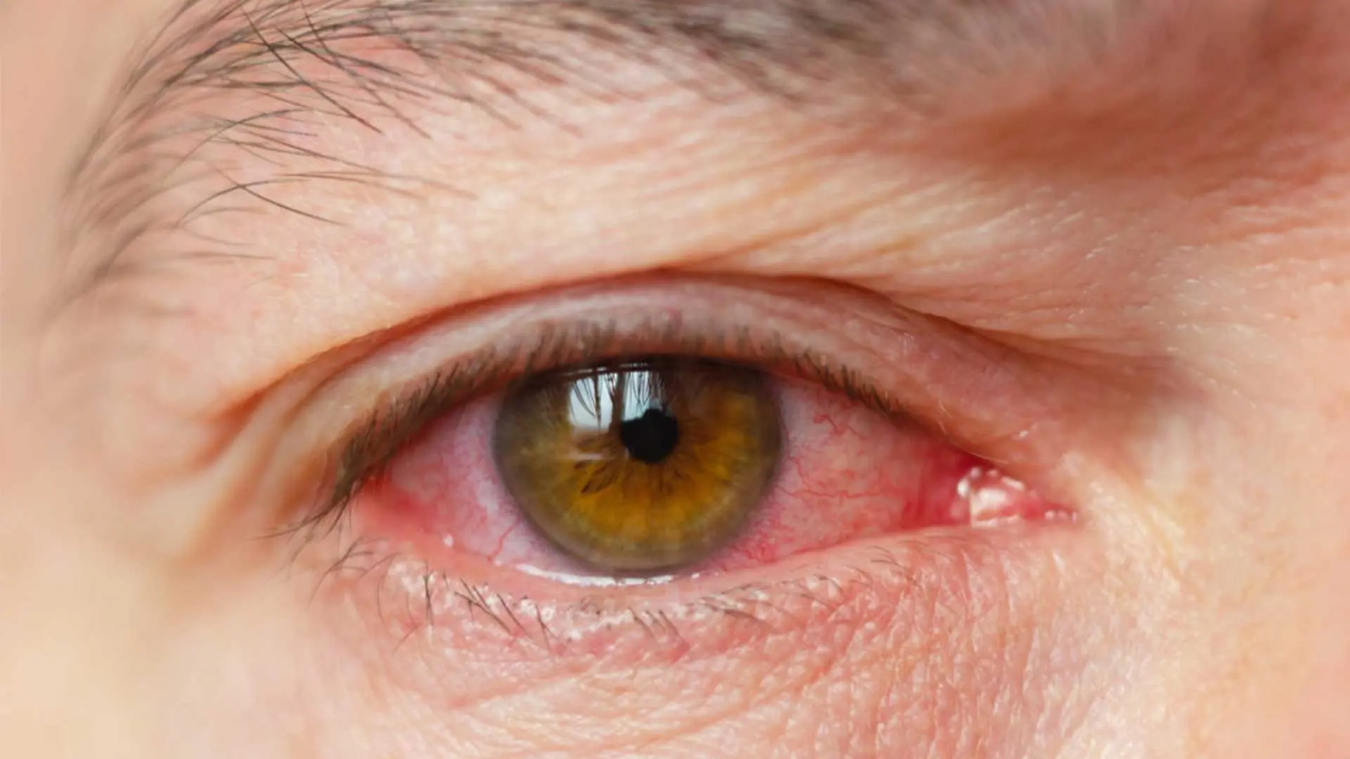 عوارض یوئیت چشم چیست؟