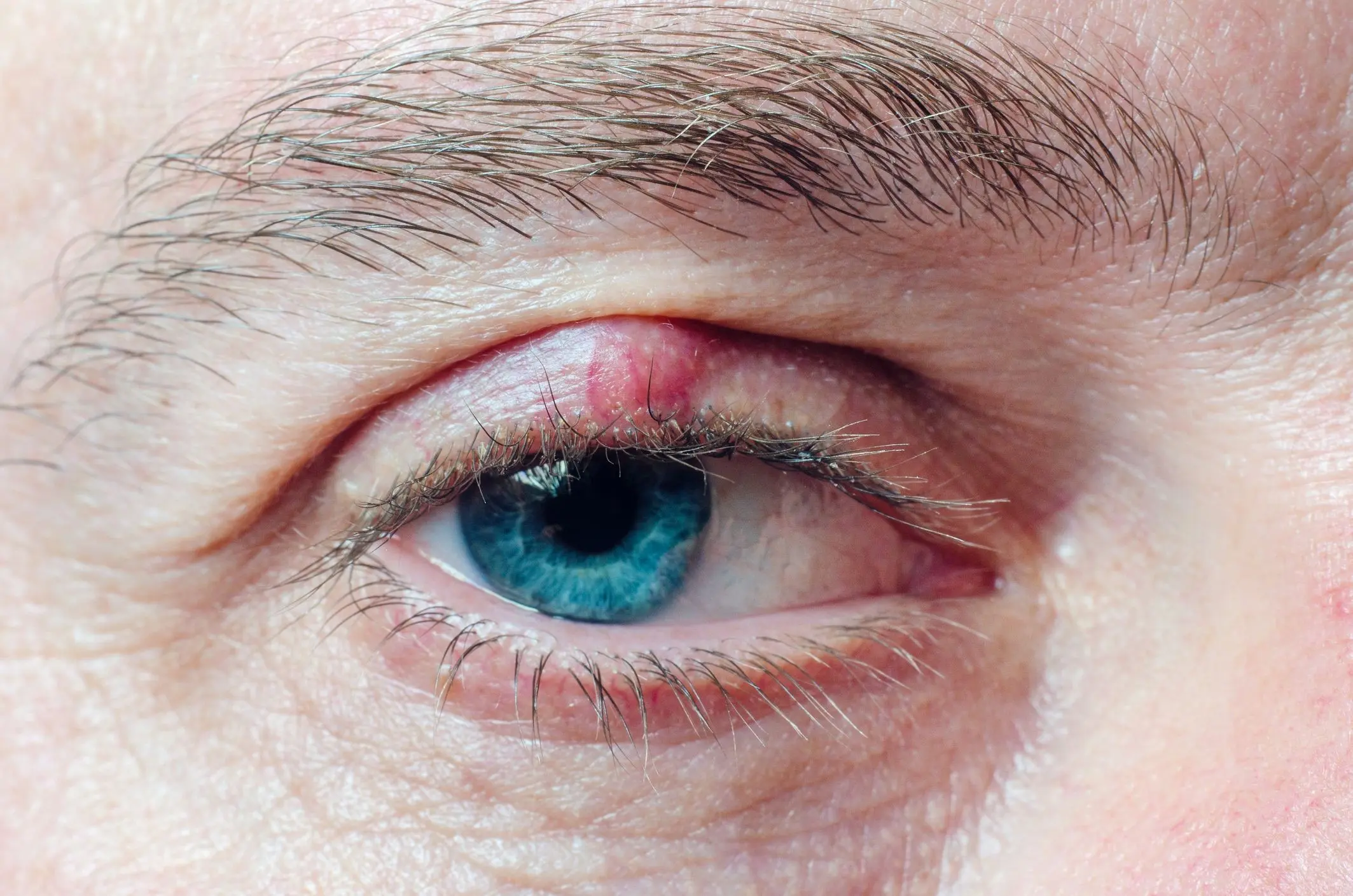 شالازیون چشم چیست؟