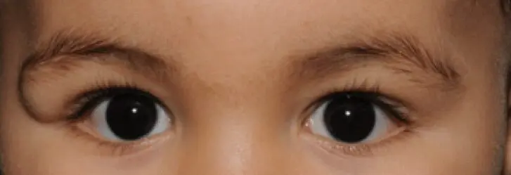 تومورهای اربیت چشم در کودکان