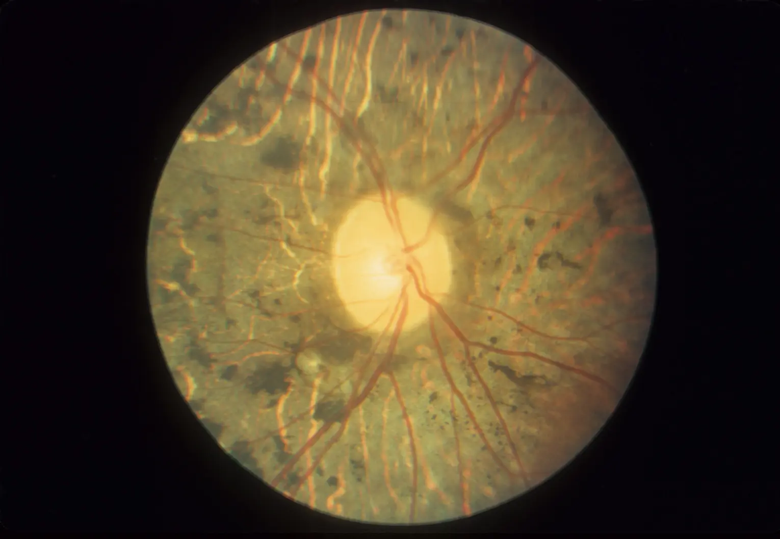 بیماری رتینیت پیگمنتوزا چشم چیست؟