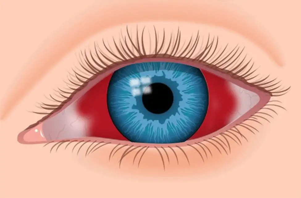دلیل لکه خون در چشم