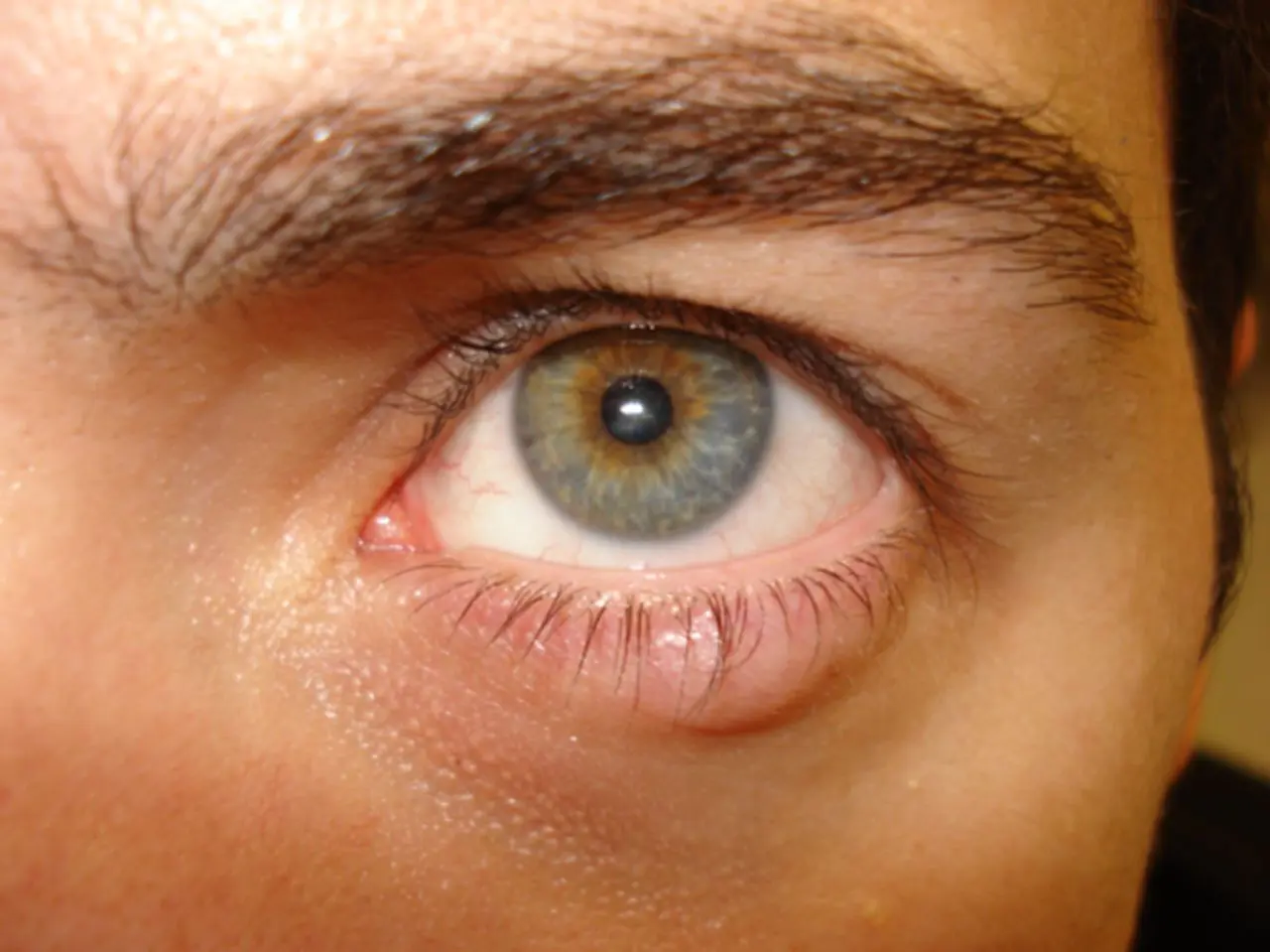 تومورهای اربیت چشم چیست؟ - دکترعینک