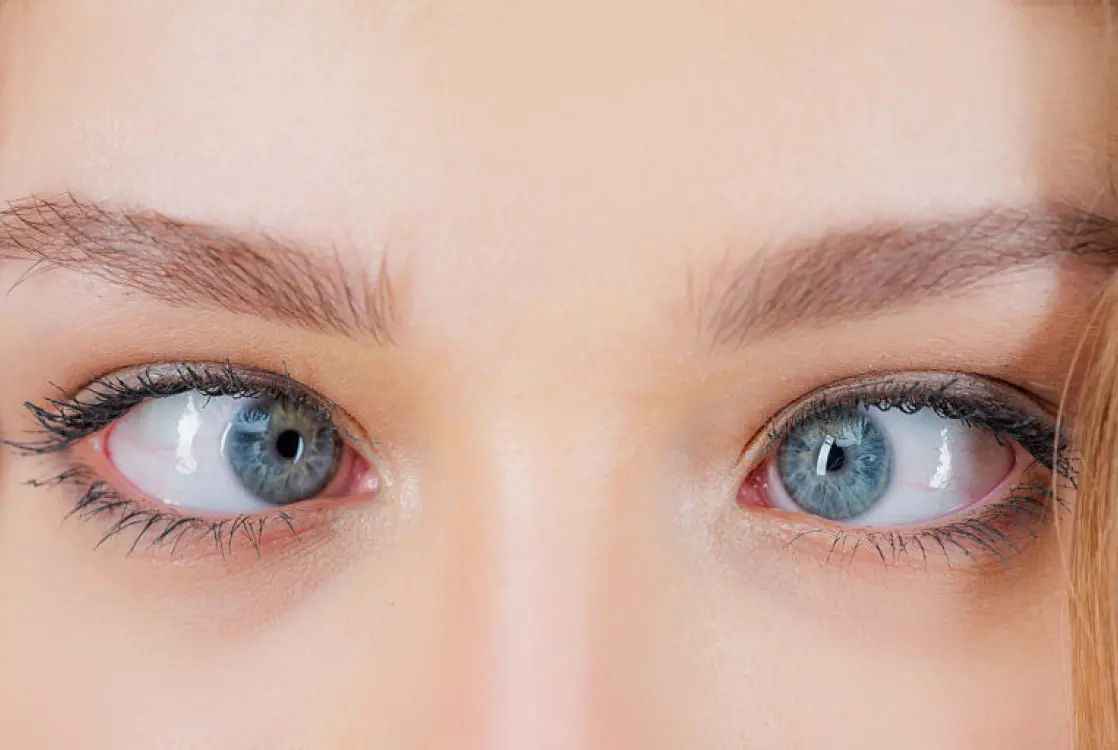 بیماری انحراف چشم چیست و چه دلایلی دارد؟ - دکترعینک