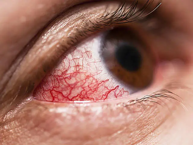 رتینوپاتی چشم چیست و چه علائمی دارد؟ - دکترعینک